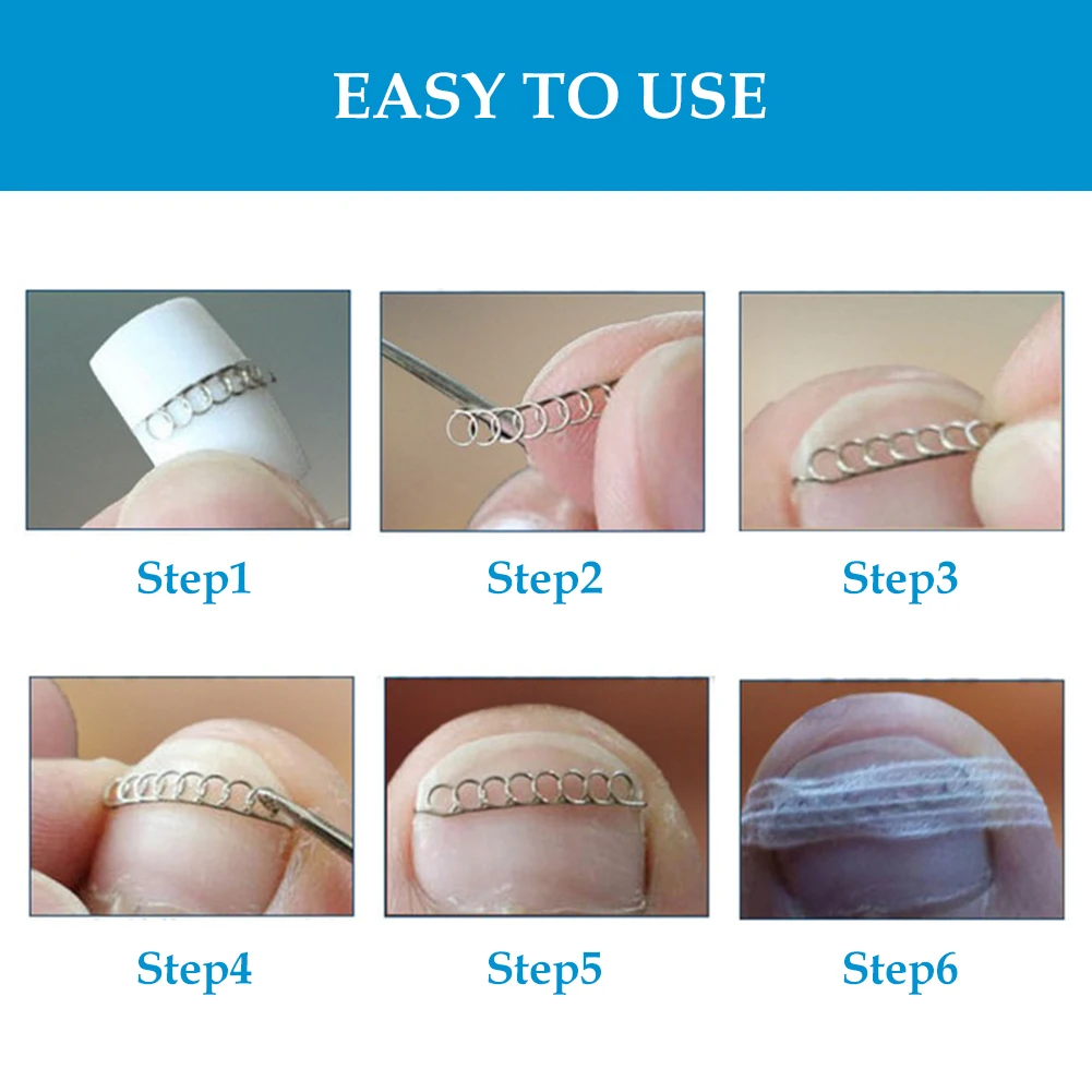 12pcs/set Clip Professional Acronyx Home Painless Wire Fixer Toenail Corrector Stainless Steel Ingrown Pedicure Healthy Recover 12pcs/set Clip Professional Acronyx Home Painless Wire Fixer Toenail Corrector Stainless Steel Ingrown Pedicure Healthy Recover