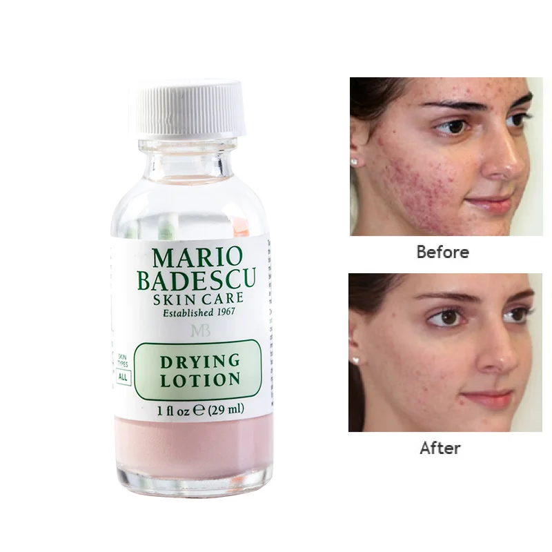 An Effective Acne Treatment Original Mario Badescu Drying Lotion