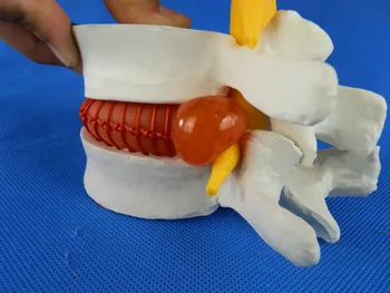 

Medical Human Lumbar Disc Herniation Demonstration Model Lumbar Lesion Pathological Lumbar Vertebrae In Department of Orthopedic