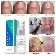 Полезное лечение грибковых ногтей, удаление грибка для рук и ног, гель для ухода за ногтями, анти-инфекция, Paronychia Onychomycosis