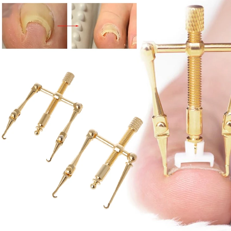 Золотое средство для коррекции вросших ногтей, средство для коррекции ступней, восстанавливающее, восстанавливающее, параническое, для ног, для ухода за ногтями