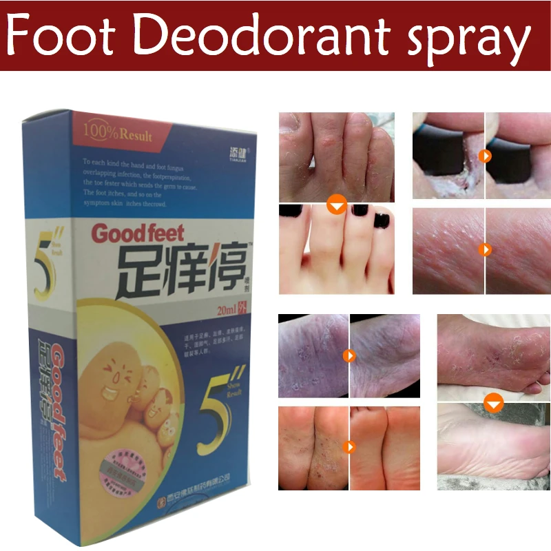 Professional Foot Care Antibacterial Deodorant Powder Anti Itch Sweat Odor Feet Liquid Anti-fungi Spray Shoe Socks New