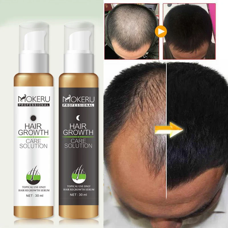 2 шт./упак. Mokeru натуральные продукты для выпадения волос быстрое восстановление волос спрей для мужчин от выпадения волос лечение мужчин т масло роста для мужчин женщин