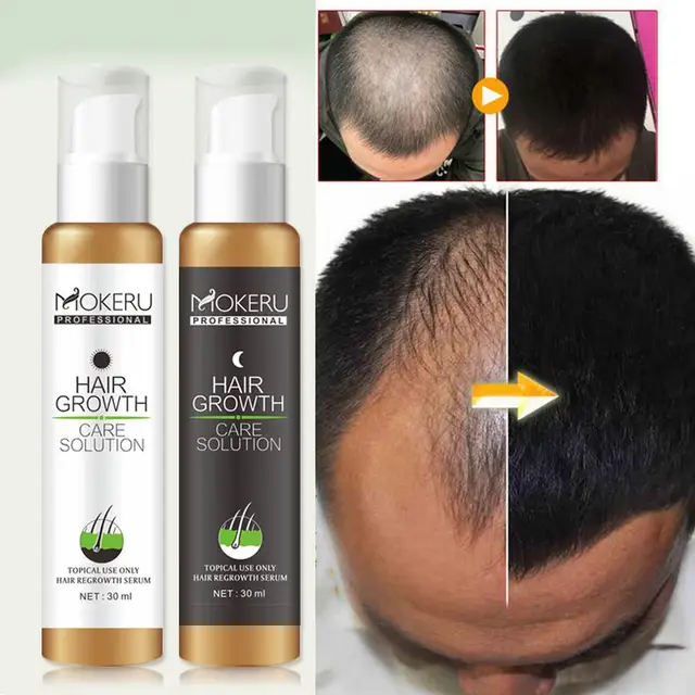 2pcs Pack Mokeru Natural Hair Loss Products Fast Hair Regrowth