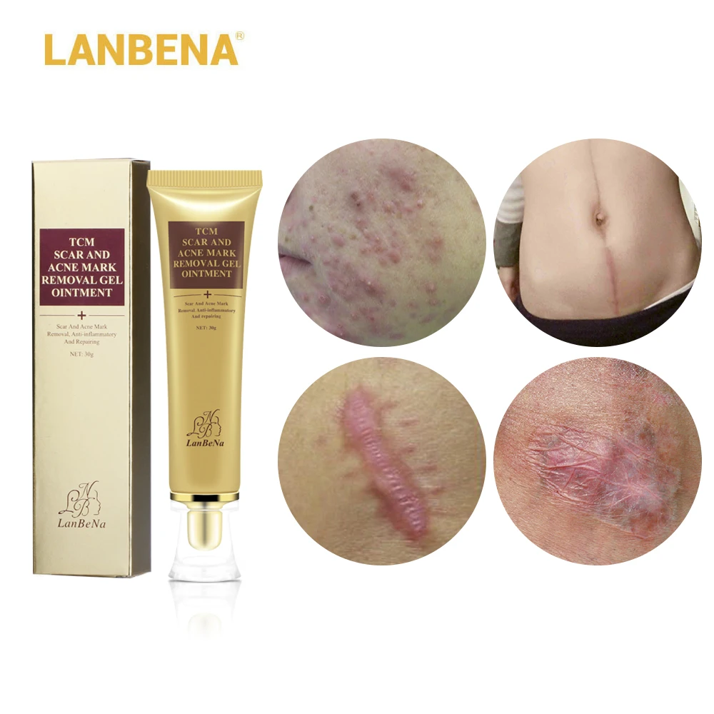 

LANBENA 30ml Acne Scar Removal Cream Skin Repair Face Cream Acne Spots Acne Treatment Blackhead Whitening Cream Stretch Marks