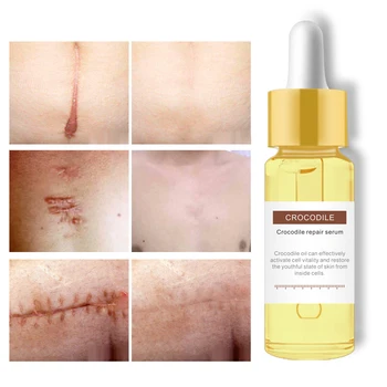 

15ml Crocodile Oil Serum Crocodile Scar Repair Serum Acne Scar Removal Whitening Dark Spots Stretch Marks Treatment Skin Care