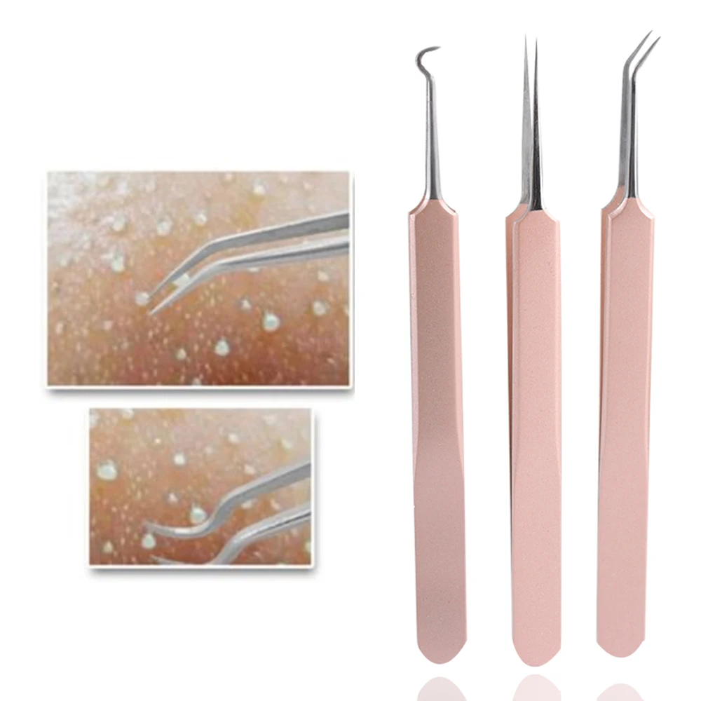 best comedone extractor kit