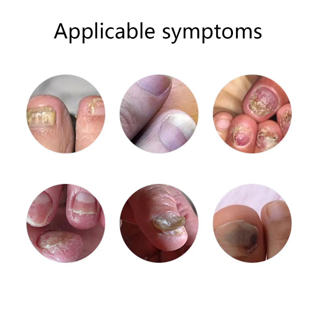 BGVfive10ml для ремонта ногтей жидкое моющее средство Onychomycosis средство для удаления грибка для дезинфекции ногтей водный продукт