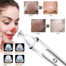 Массажное прозрачное очищающее средство от черных точек для удаления Белый ABS Быстродействующее эффективное 3 скоростное удаление черных точек