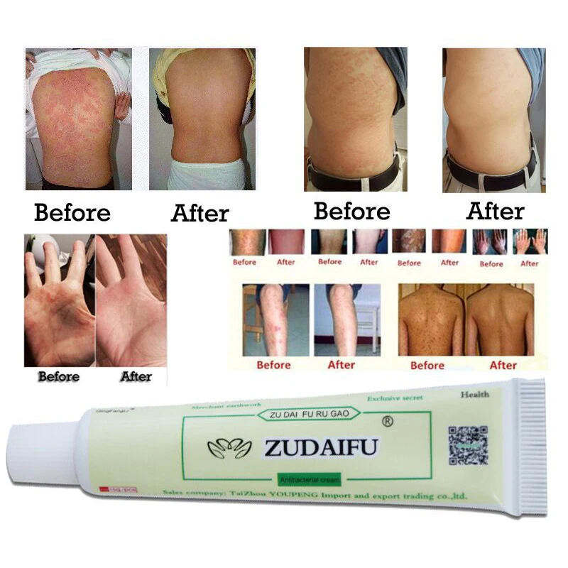 Мазь для тела Zudaifu, псориаз, крем для ухода за кожей, дерматит, экзематоид, крем для лечения Eczema, 15 г, антибактериальное Очищение лица, против акне