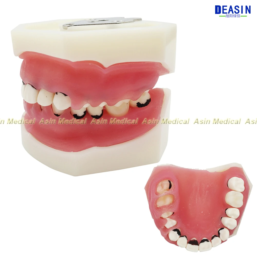 Новинка модель для изучения заболеваний Стоматологическая модель|dental periodontics|dental