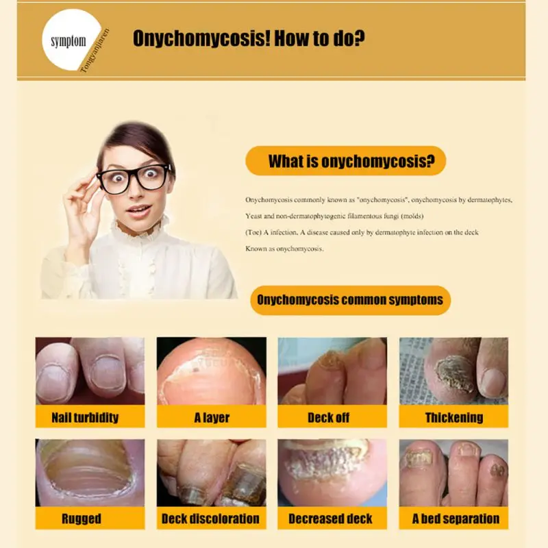 Nail Gel Pure Plant Fungal Nail Treatment Essence Nail and Foot Whitening for Cuticle Oil Toe Nail Fungus Removal Feet Care Nail Gel Pure Plant Fungal Nail Treatment Essence Nail and Foot Whitening for Cuticle Oil Toe Nail Fungus Removal Feet Care