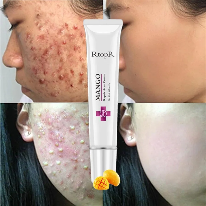 

Anti-acne Spot Treatment Scar Blackhead Shrink Pores Professional Acne Repair Acne Cream Moisturizing Facial Skin Care TSLM1
