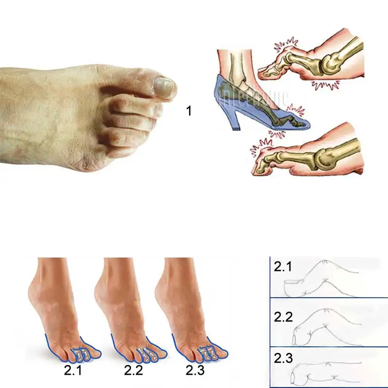 1 пара молоток разделитель пальцев ног вальгусная деформация ортопедические подушки подгибка деформация Наложение стопы коррекция носка носки