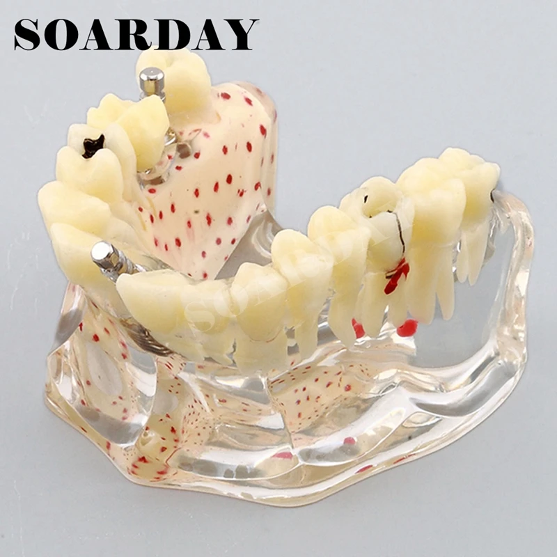 Implant Dental Model for Upper teeth Implant Spongy Bone Carious (1)