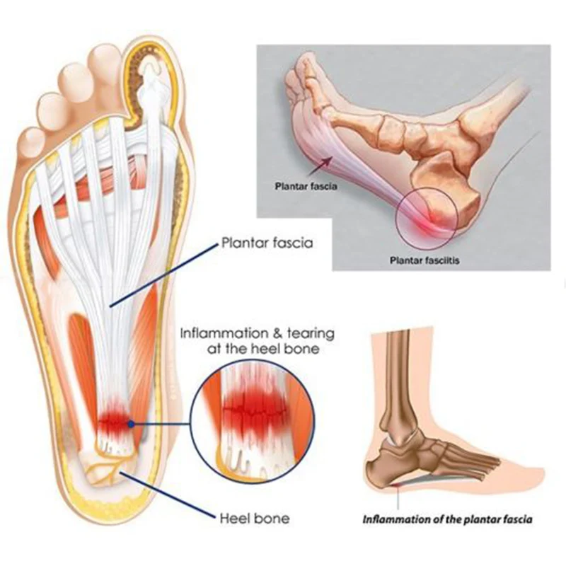  Adjustable plantar fasciitis night splint motion pain relief toe foot support massage tool WS99