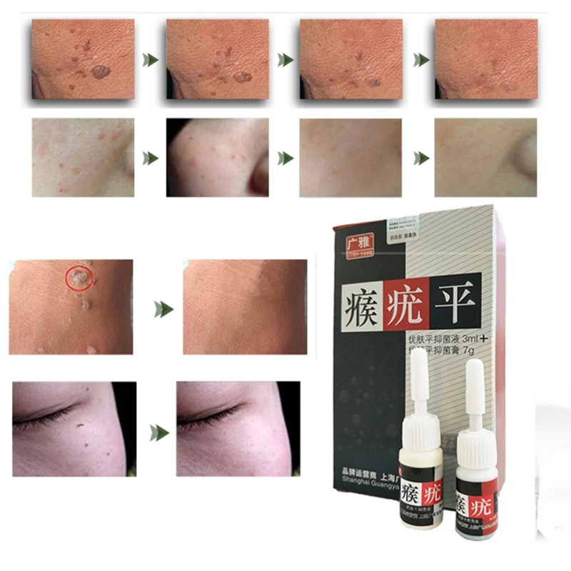 Mole& Skin Tag Repair Solution Painless Mole Skin Dark Spot Repair Face Wart Tag Verruca Treatment Essence skin tag remover tool Mole& Skin Tag Repair Solution Painless Mole Skin Dark Spot Repair Face Wart Tag Verruca Treatment Essence skin tag remover tool