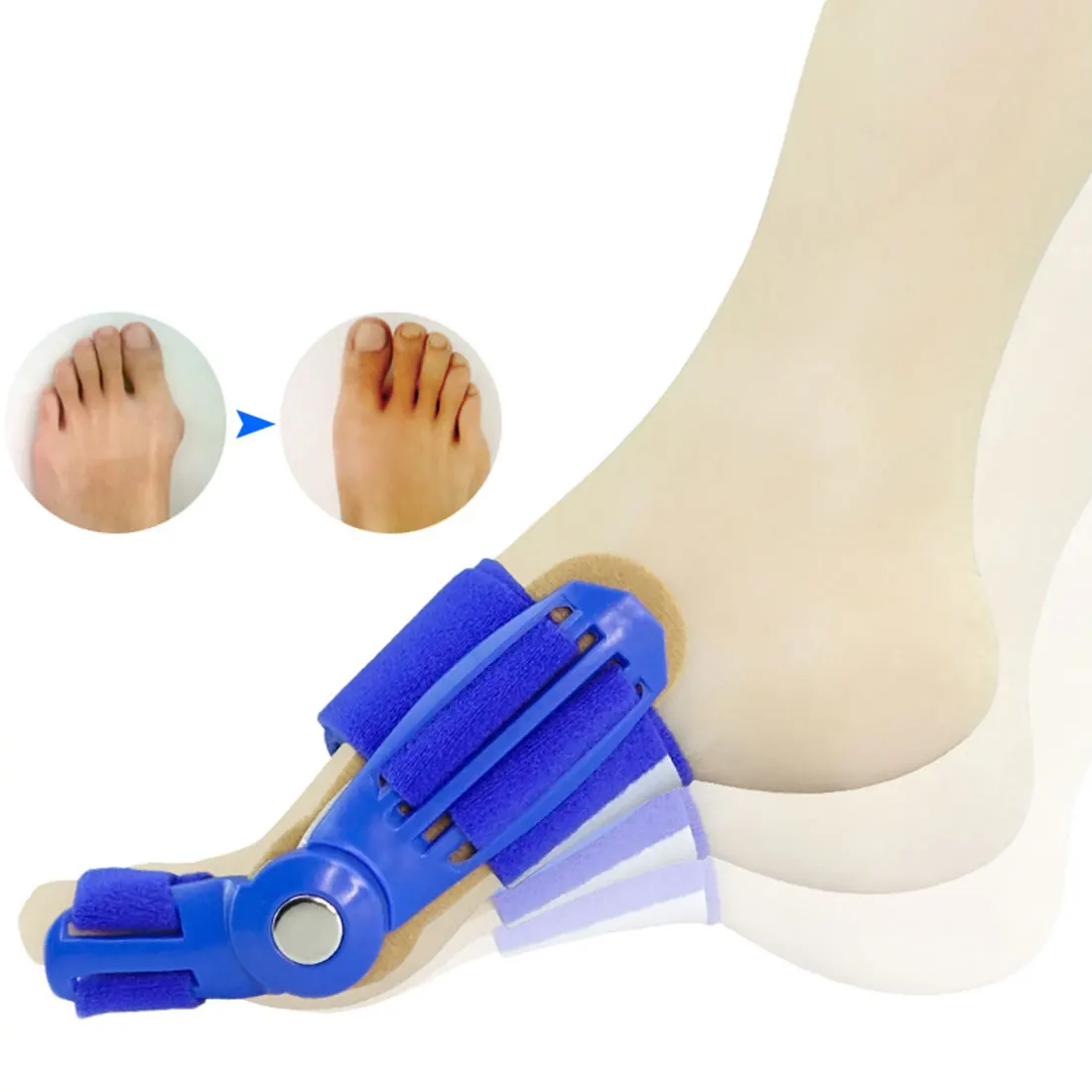 Medical Device Big Toe Corrector /1Pcs Bunion Splint Corrector /Hallux