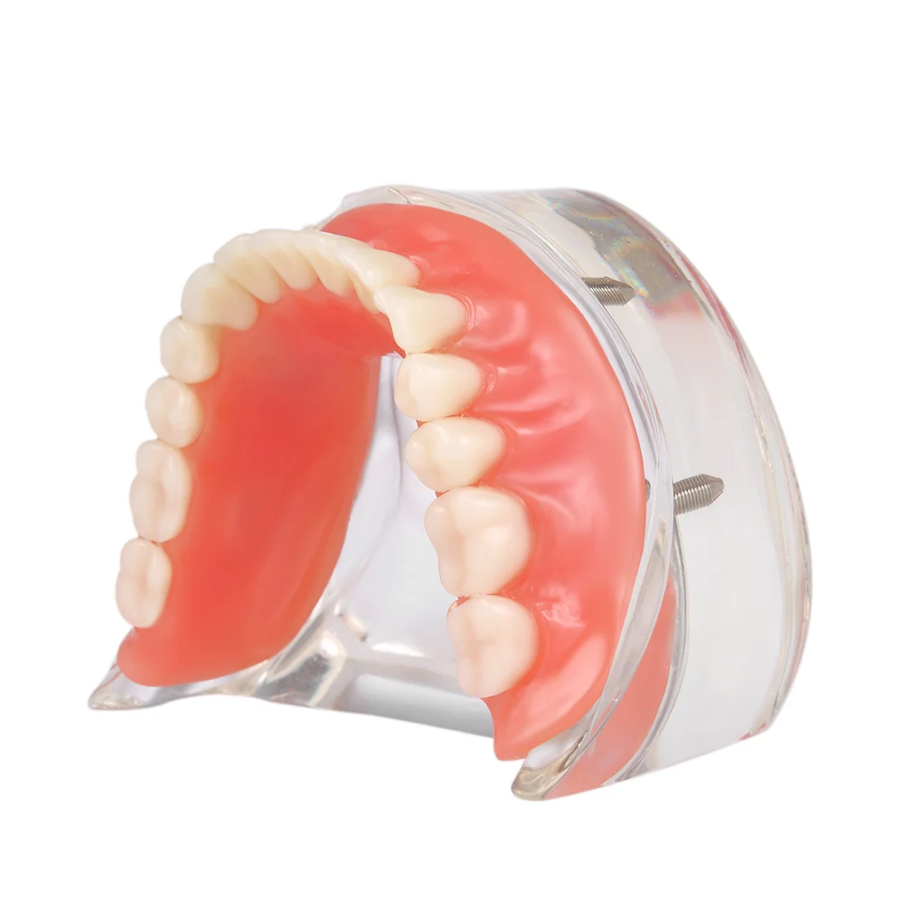 

Dental Teeth Study Model Dental Overdenture Interior Mandibular Lower Jaw Teeth Mandibular Model 4 Implant for Tooth Teaching