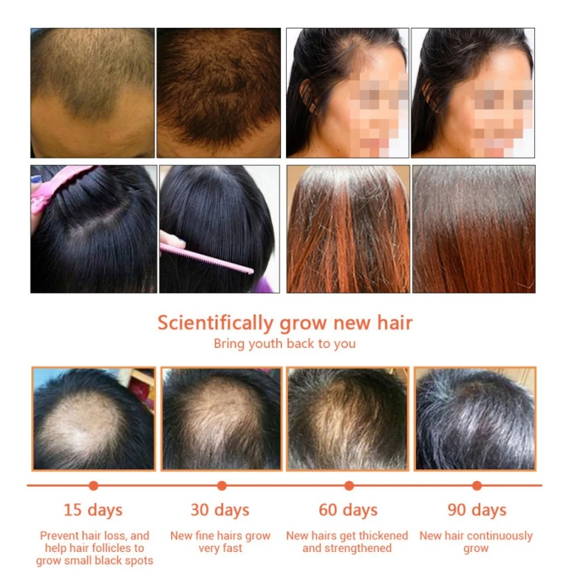 Для женщин Для мужчин роста волос Сыворотки Сущность против выпадения волос жидкость ремонт растет быстрее ремонт продукт потери волос