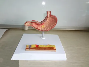 

Gastric anatomy model Gastrointestinal Gastric ulcer model Digestive system