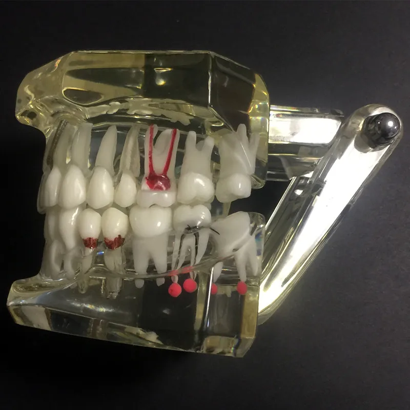 Стоматологическая имплантатная модель зубов с восстановительным мостом анатомическая Ортодонтическая модель для медицинских исследований