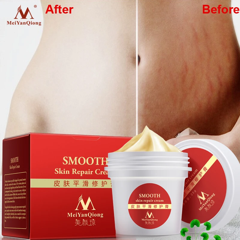 Meiyanqiong Крем для гладкой кожи для Удаления растяжек и шрамов для восстановления кожи тела крем для удаления шрамов после родов