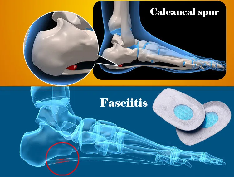 Heel-pain-XD-005-(17)