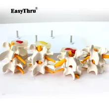 Demonstration Model Lumbar Vertebral Spine Model Pathological vertebrae model Quadrilateral lumbar disease model medical art anatomic model of kidney pathological model of kidney