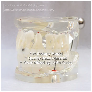

DH/13067, Clear Mixed age with Caries, Pathology Dental Model, Medical Science Educational Teaching Anatomical Models