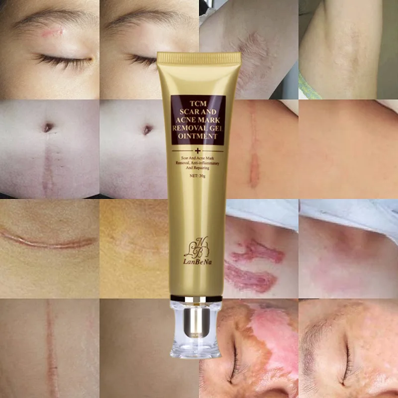 

5 PCS LANBENA Stretch Marks Remove Acne Treatment Face Whitening Pimple Scar Pregnancy TCM SCAR AND ACNE MARK REMOVAL GEL 30g
