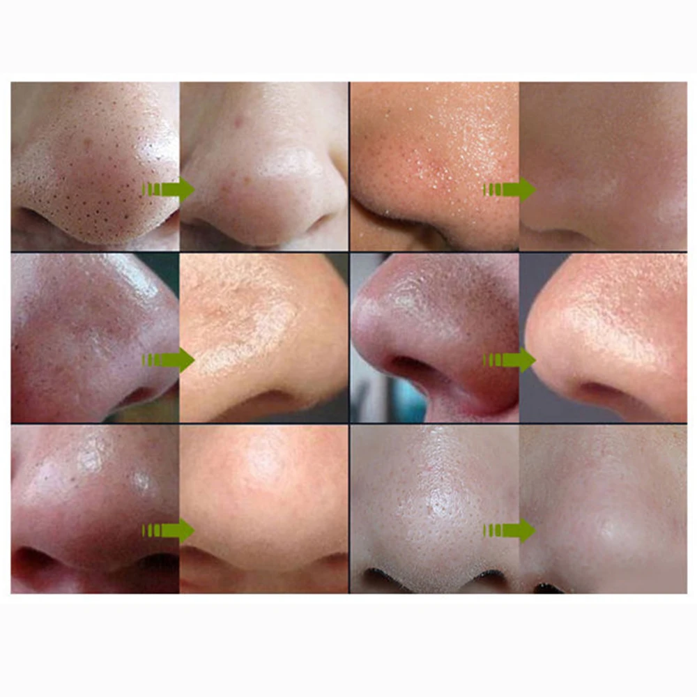 5 шт. маска для носа с угольным напылением|skin care|skin cleansingskin pore |