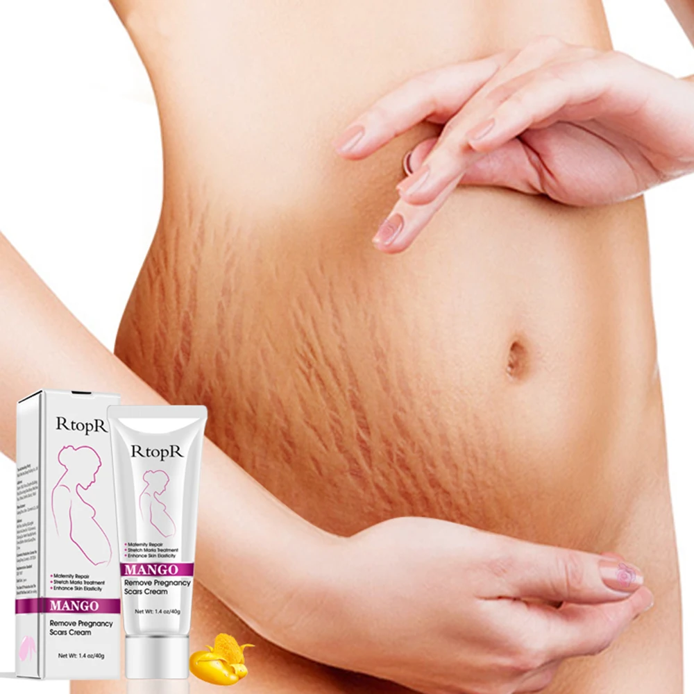 RtopR Natural Mild Non-irritating Mango Stretch Mark Cream Pregnancy Repair Scar Slack Line Abdomen Stretch Marks Cream TSLM1