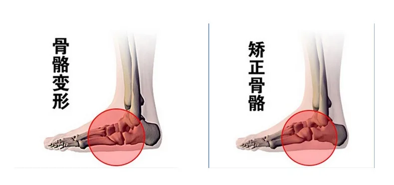 Ортопедические стельки для плоской стопы X-Leg 8-Shaped для коррекции ног стелька под пятку стельки для поддержки стопы ортопедические стельки из овчины 39-44