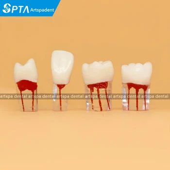 

Dentistry Exam Practice open pulp root canal model in vitro dental pulp cavity