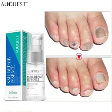 Высокое качество 20 мл лечение грибков ногтей Удаление онихомикоза против грибка Уход за ногтями ремонт