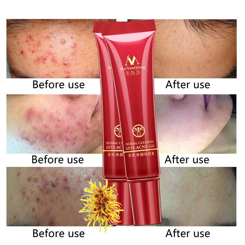 2PCS Skin Care Acne Cleaning Cream Remove Repair Comedone Pimple Acne