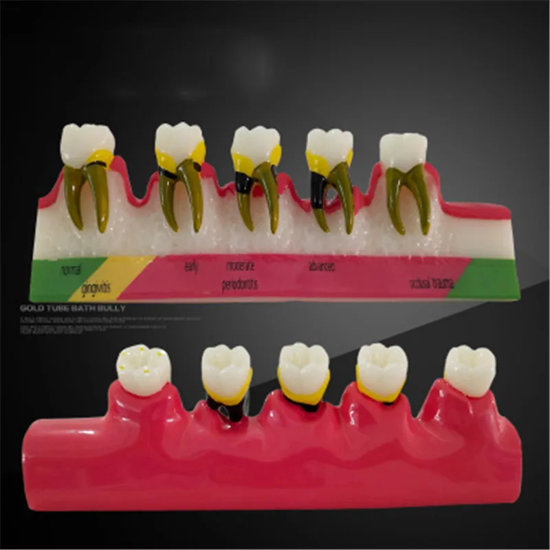 Зубные кариес модель обучение распад зубов Модель уход за зубами зубная модель для обучения зубной лаборатории модель зубного материала