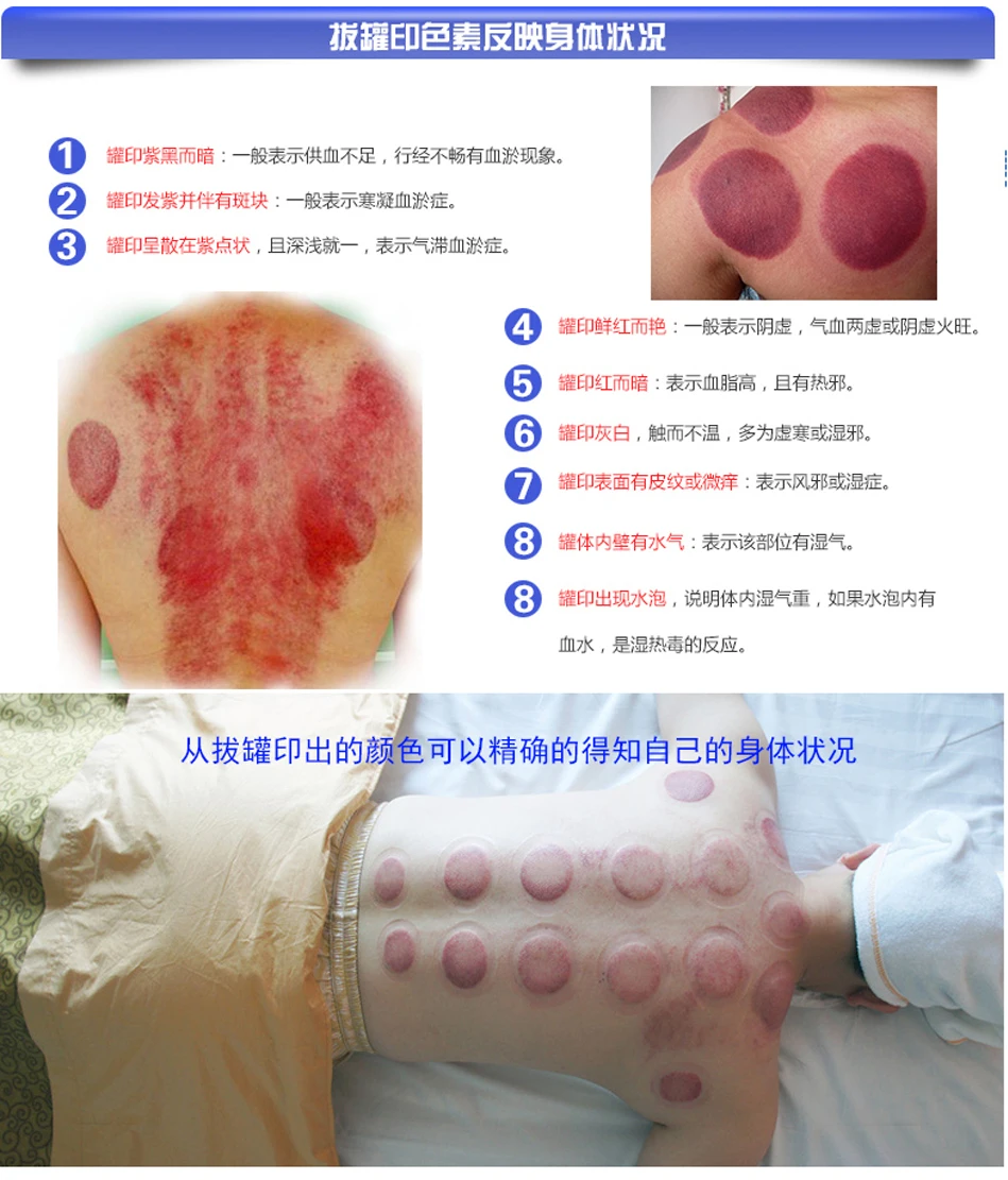 YL0027-Cupping-device_19