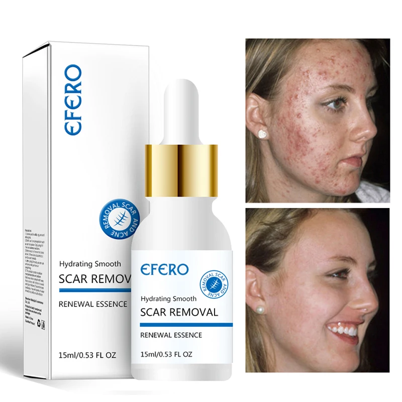 efero 15ml Face Serum Lighten Acne Blackhead Hyaluronic Acid