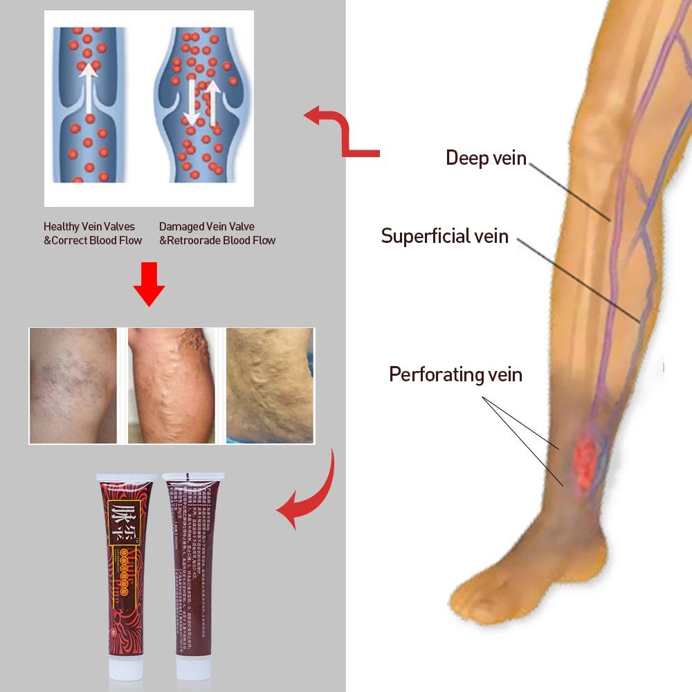 Крем для лечения варикозного расширения вен, мазь, васкулит, флебит, Паучья боль, варикозность, ангиит, средство для удаления травяного крема P1003