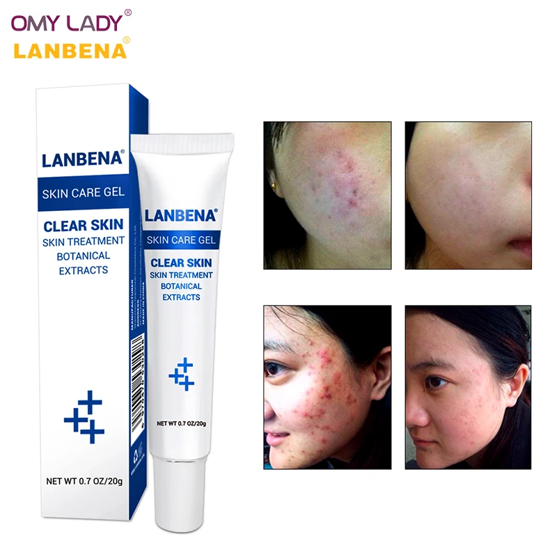 OMY LADY LANBENA крем для лечения акне уход за кожей средство удаления гель сокращения