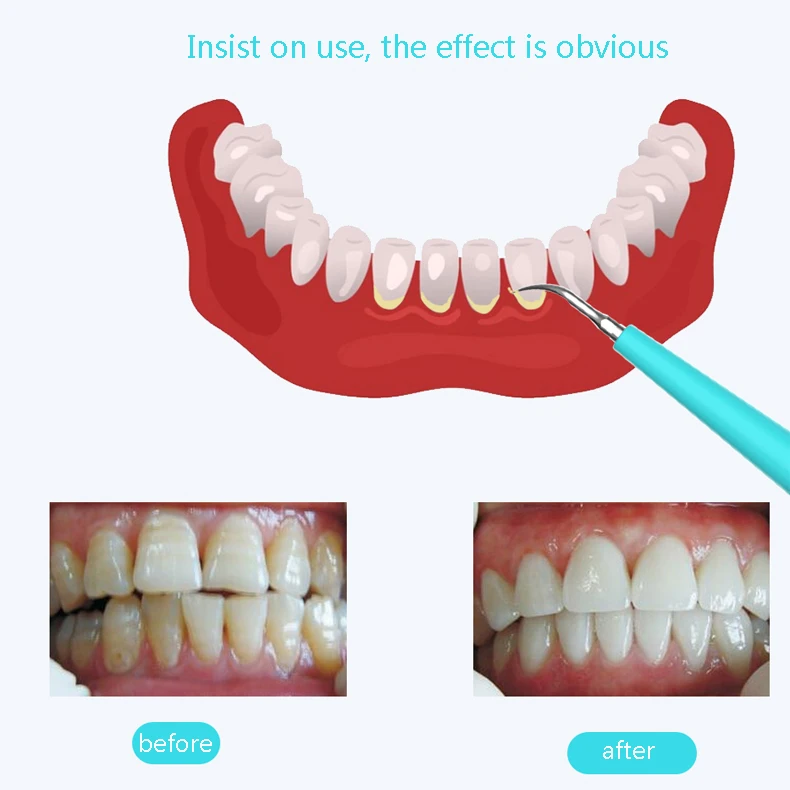Электрический зубы Отбеливание зубов инструмент зубные пятна Calculus удалить скалер звуковая вибрация домашнего использования зубная