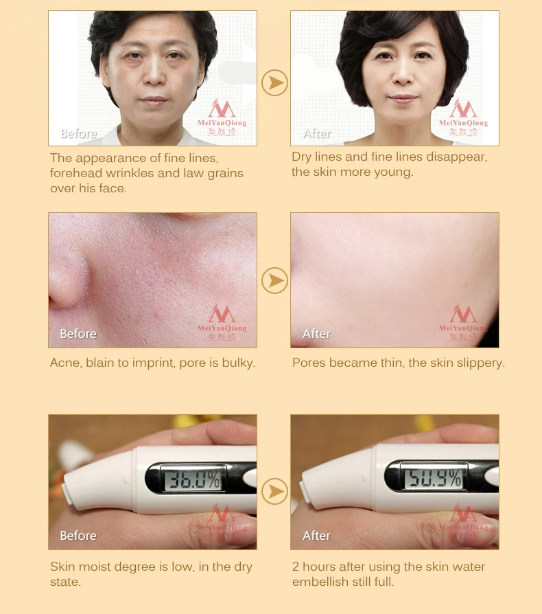 MeiYanQiong сывороточная эссенция для лица чистый растительный экстракт жидкая Улитка Гиалуроновая кислота Омолаживающая отбеливающая Сыворотка для кожи против акне