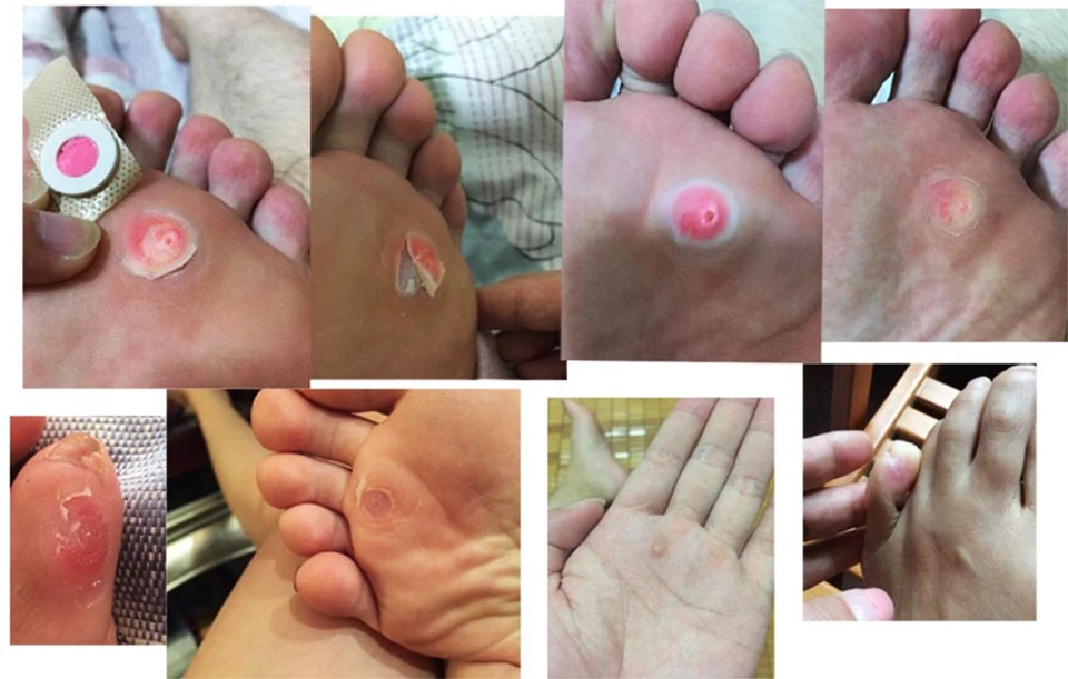 MQ 12 Pieces=2 Boxes Corn Callus Remover Patch Medical Plaster Health Care Corn Cutter Foot Callus Removal