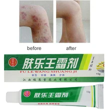 Material Herbal Psoriasis cremas dermatitis eccema Psoriasis prurito ungüento crema corporal sin caja al por menor