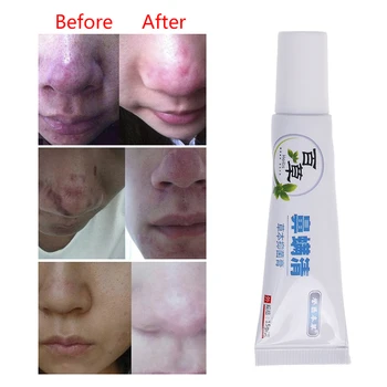 

15g Nose Cleaning Cream Rosacea Treatment Cream Nose Redness Removal Cleaning Antibacterial Gel Skin Care Product