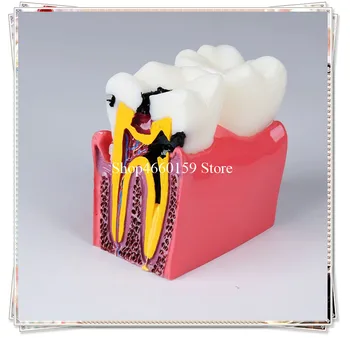 

Dental Caries teeth Model 6X Compares the health and caries tooth/Dentist Pathologies Caries Comparison model for dental study