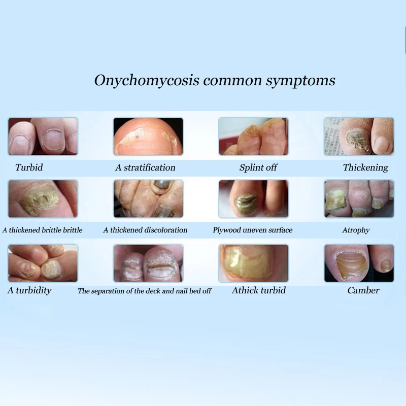 kezelés fungi nail antibiotikumok