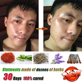 

Scar Removal Cream Ginseng Extract Skin Care Repair Spots Acne Treatment Stretch Marks facial blackhead Bleaching Cream